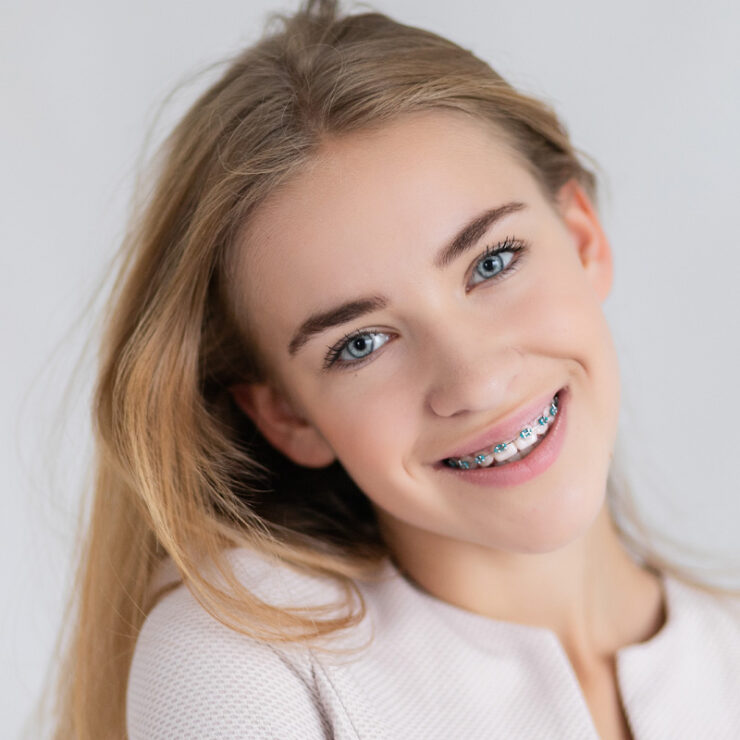 Braces Without Extractionst