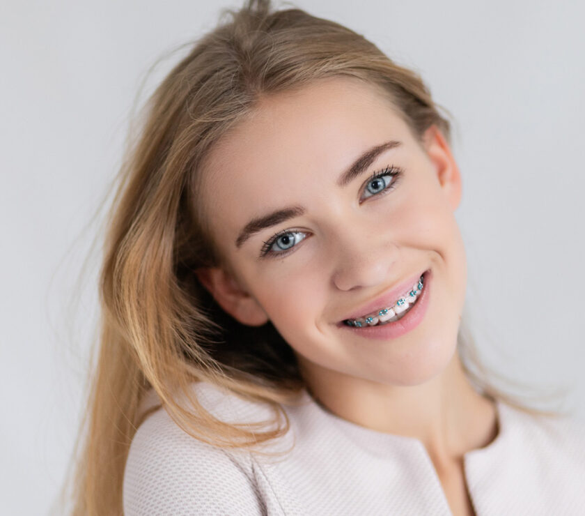 Braces Without Extractionst