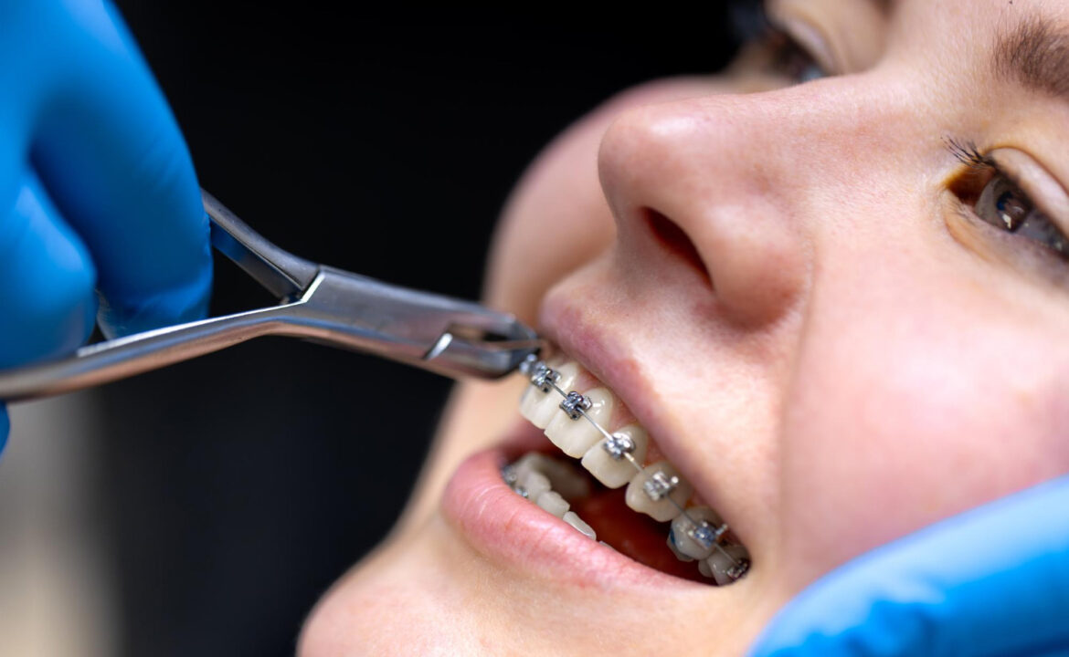 Self Ligating Braces