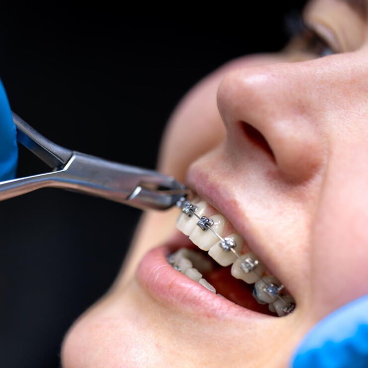 Self Ligating Braces