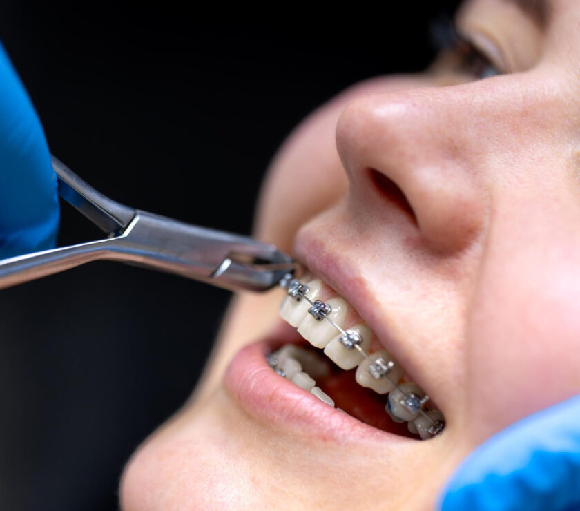 Self Ligating Braces