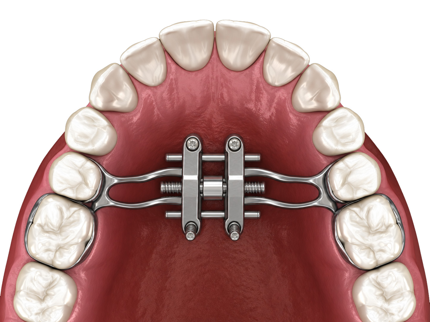 MARPE palatal expander
